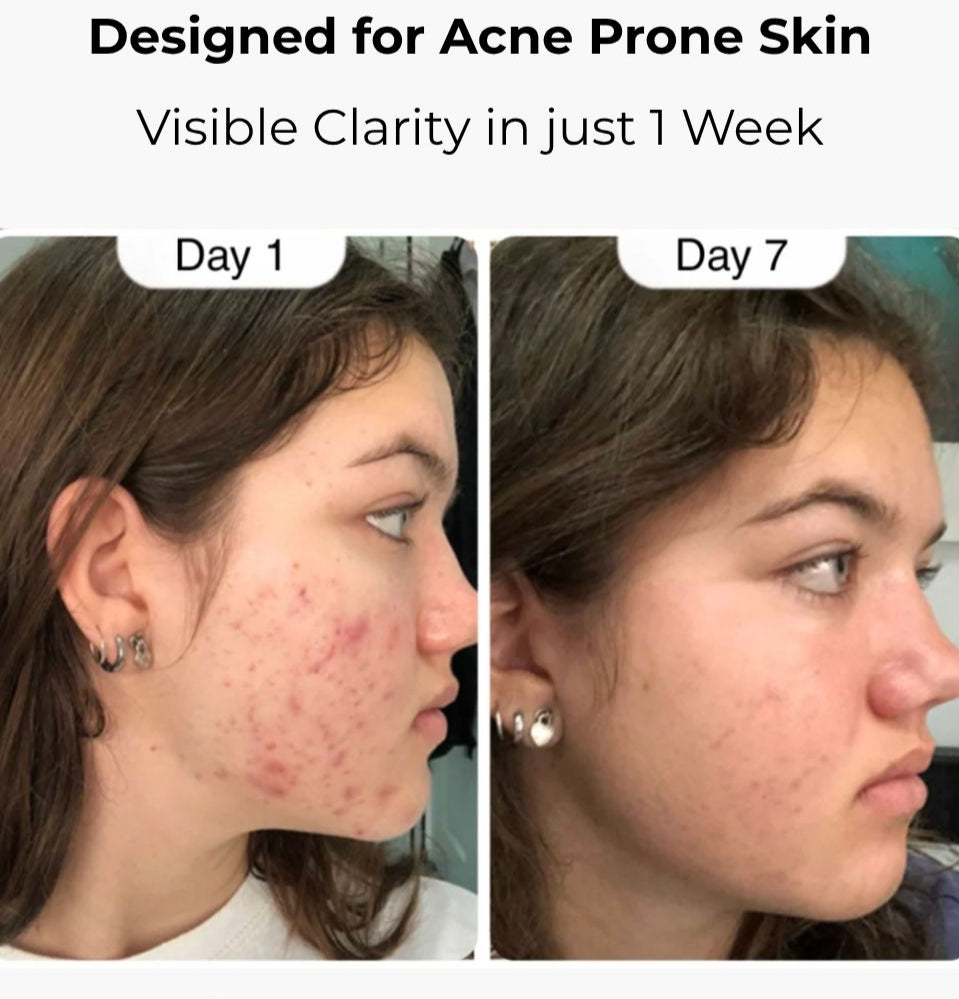 Hypochlorous Acid Spray