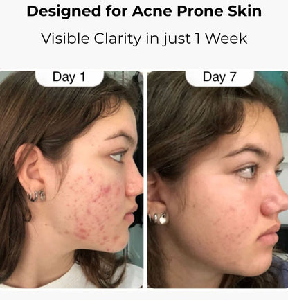 Hypochlorous Acid Spray